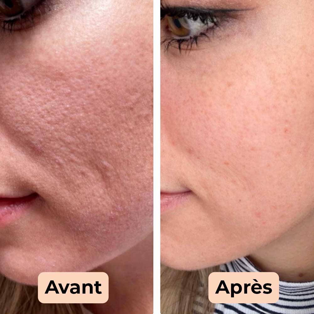 Korean peel shot exfoliant